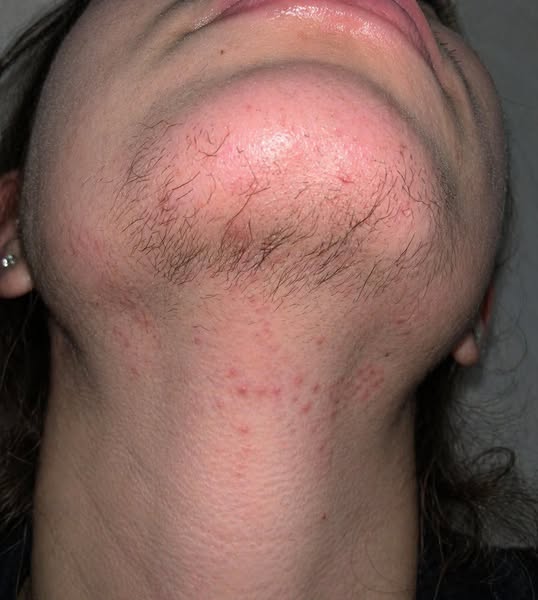 Ingrown hairs flaring up in the same spots from distorted follicles