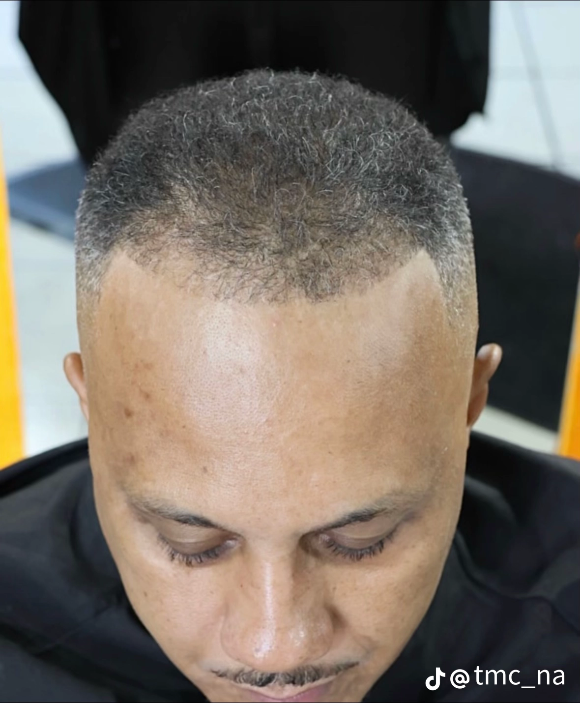 Hairline before application