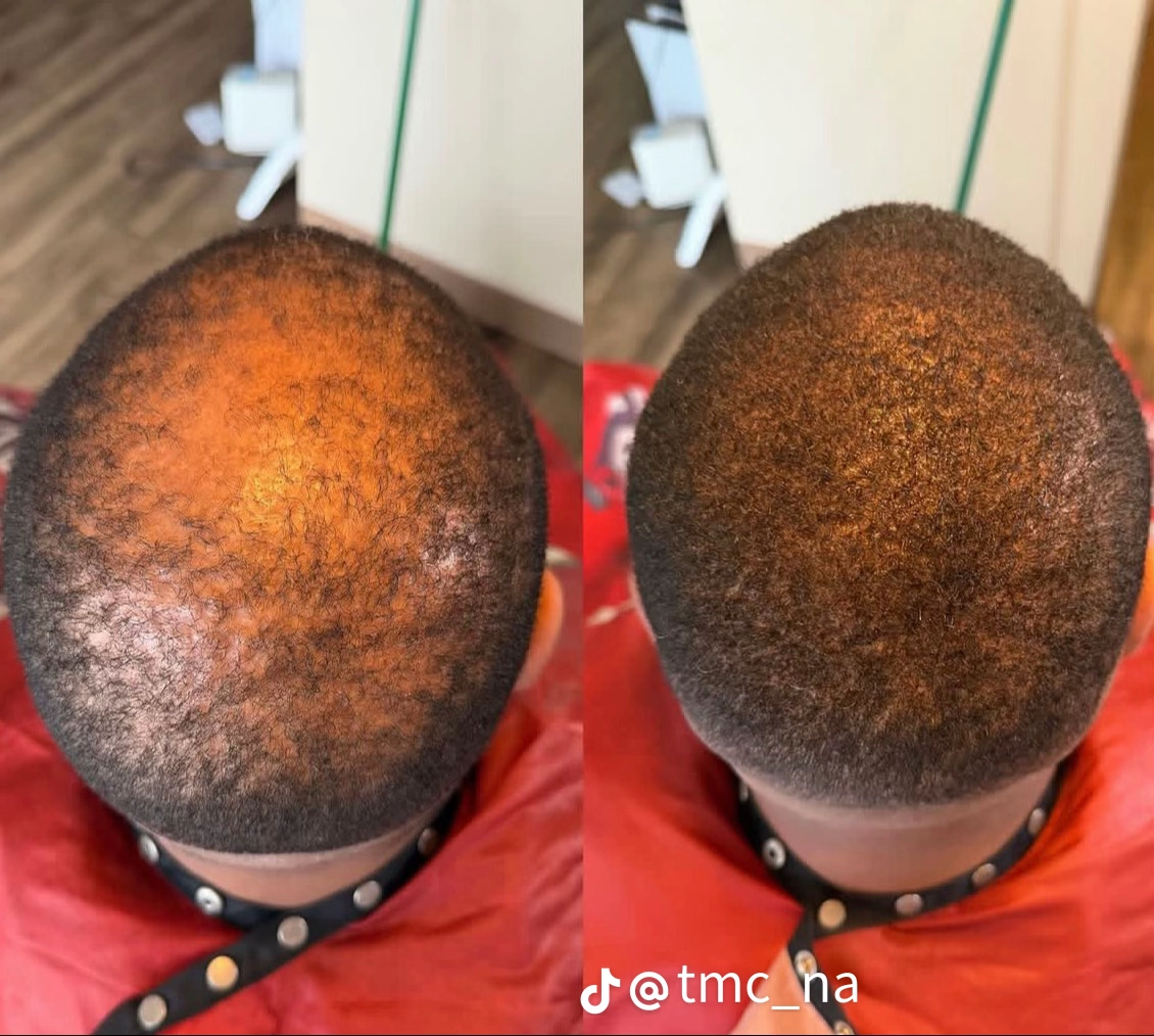 A full looking crown after application